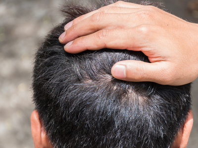 Close-up of a man’s hand placed on the back of his head, revealing early signs of hair thinning - commonly associated with male pattern baldness and conditions treated by finasteride in the Philippines.