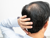 Can Hair Loss Be Reversed? Early Signs to Act On
