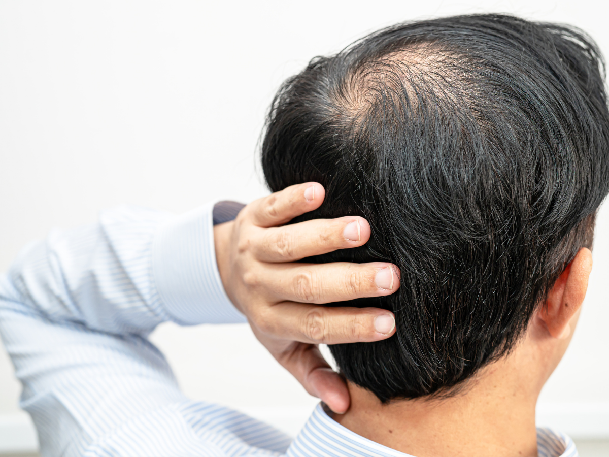 Back view of a middle-aged man with visible hair thinning on the crown of his head, touching his scalp, representing male pattern baldness and hair loss concerns - Andyou.ph