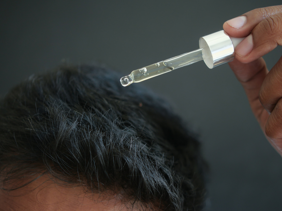 Close-up of a man's hand applying minoxidil serum using a dropper onto thinning hair on the scalp, illustrating a common non-surgical treatment for hair loss.