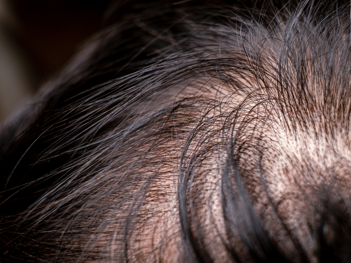 How Much Hair Loss Is Normal in the Philippines? - Andyou.ph