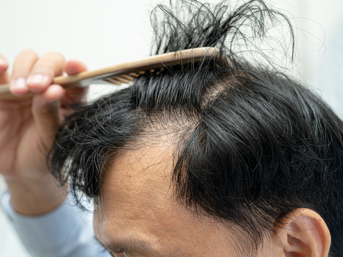 Why Men in the Philippines Are Losing Their Hair (And What to Do About It) - Andyou.ph