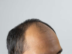 Signs of Male Pattern Baldness in the Philippines and How to Prevent It